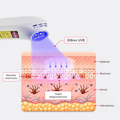 ZJKZTOP 308nm Handheld UVB Light Therapy Device