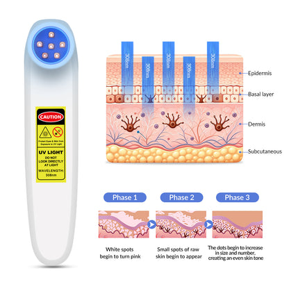 Portable 308nm UVB Phototherapy Wand for Vitiligo