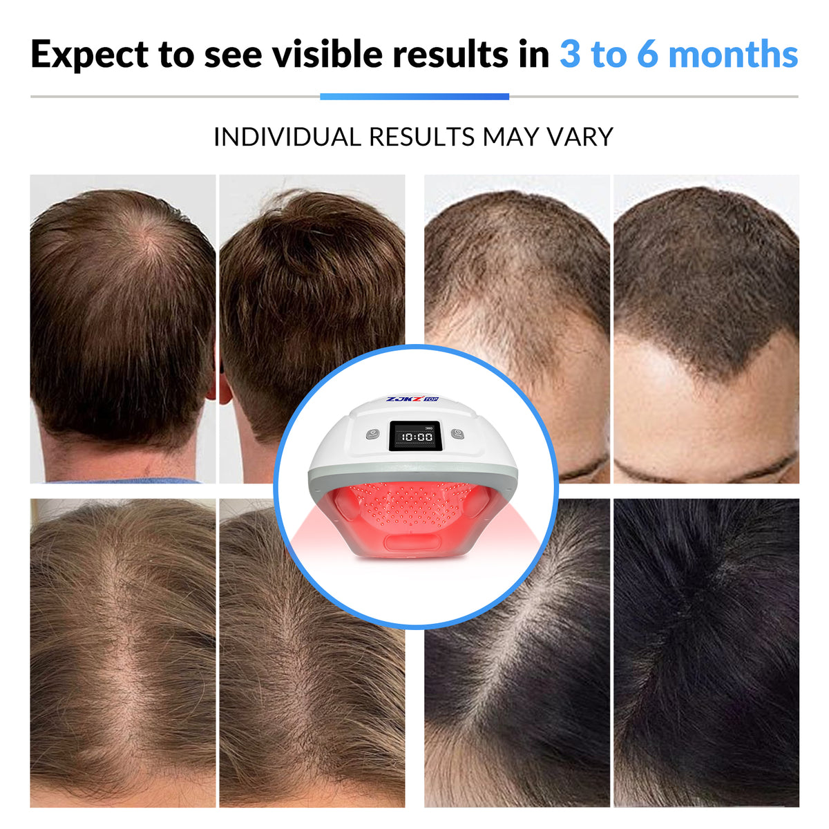 ZJKZTOP 650nm LLLT Hands-Free Laser Hair Growth Helmet
