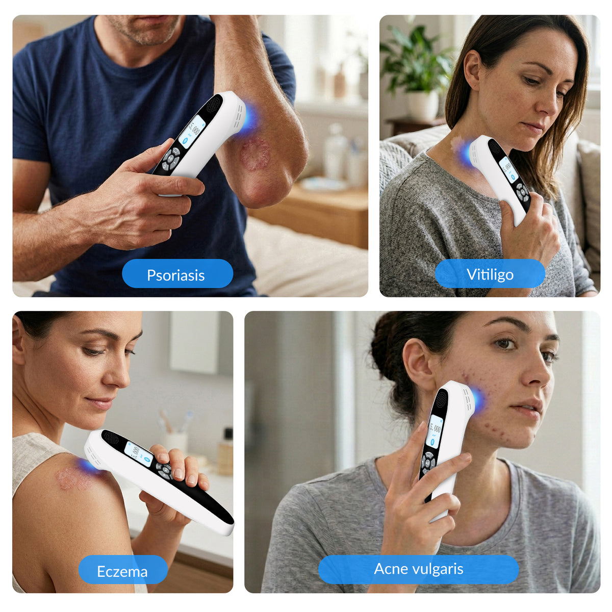 Portable 308nm UVB Phototherapy Wand for Vitiligo